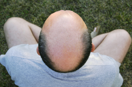 hair_loss