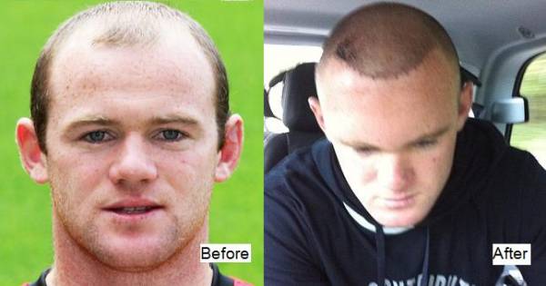 rooney-before-and-after-transplant